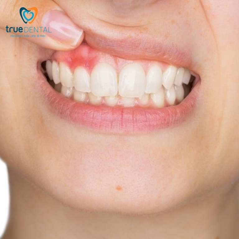 NIỀNG RĂNG BỊ SƯNG, VIÊM LỢI: NGUYÊN NHÂN VÀ CÁCH CHỮA TRỊ 1 tình trạng sưng viêm lợi