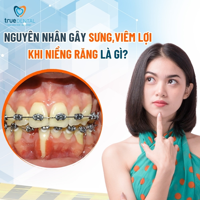 NIỀNG RĂNG BỊ SƯNG, VIÊM LỢI: NGUYÊN NHÂN VÀ CÁCH CHỮA TRỊ 2 Nguyên nhân gây viêm lợi khi niềng răng
