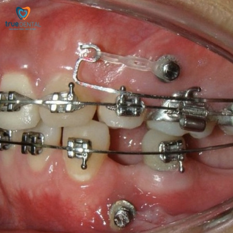 NIỀNG RĂNG BỊ TIÊU XƯƠNG: NGUYÊN NHÂN, CÁCH PHÒNG NGỪA VÀ KHẮC PHỤC 1 Niềng răng bị tiêu xương là gì?