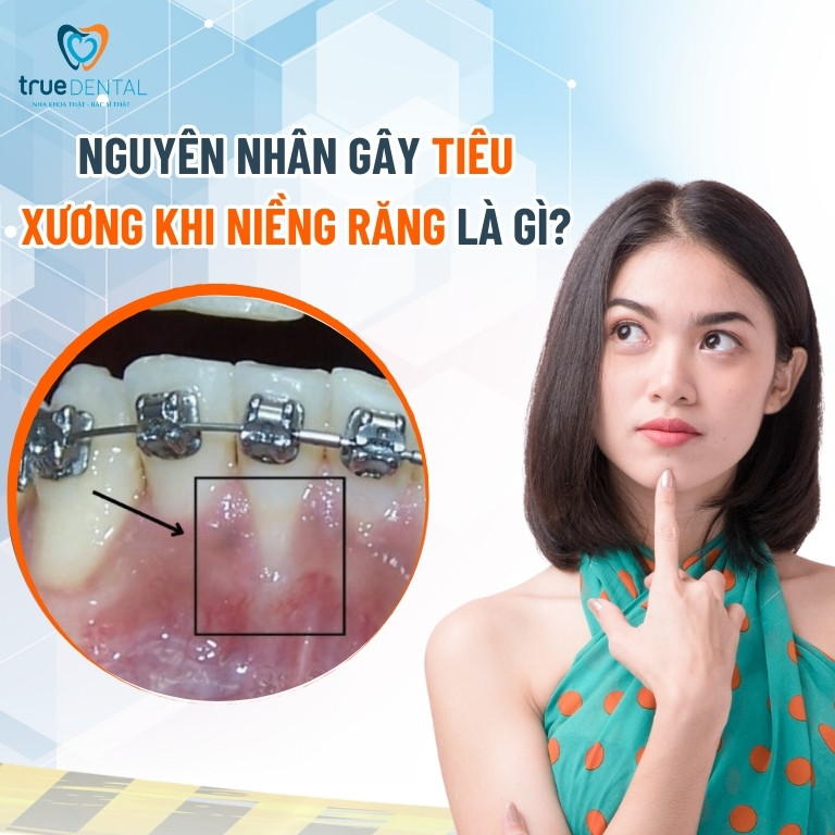 NIỀNG RĂNG BỊ TIÊU XƯƠNG: NGUYÊN NHÂN, CÁCH PHÒNG NGỪA VÀ KHẮC PHỤC 2 Nguyên nhân gây tiêu xương khi niềng răng