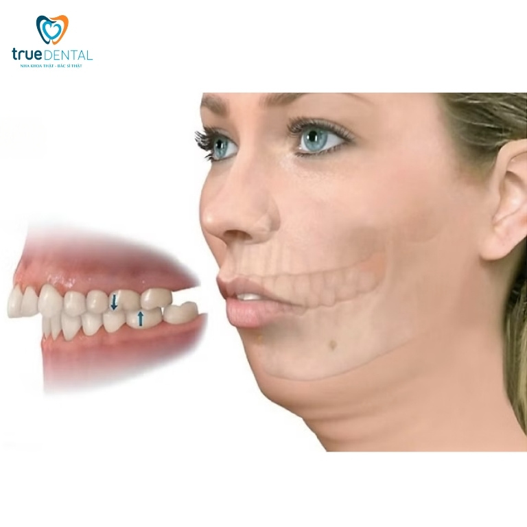 NIỀNG RĂNG HÔ: PHƯƠNG PHÁP, QUY TRÌNH VÀ CHI PHÍ CẦN BIẾT 1 Răng hô là gì?