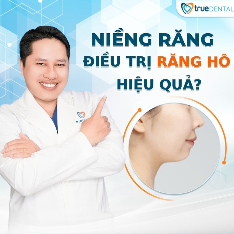 NIỀNG RĂNG HÔ: PHƯƠNG PHÁP, QUY TRÌNH VÀ CHI PHÍ CẦN BIẾT 2 Tại sao nên niềng răng hô?