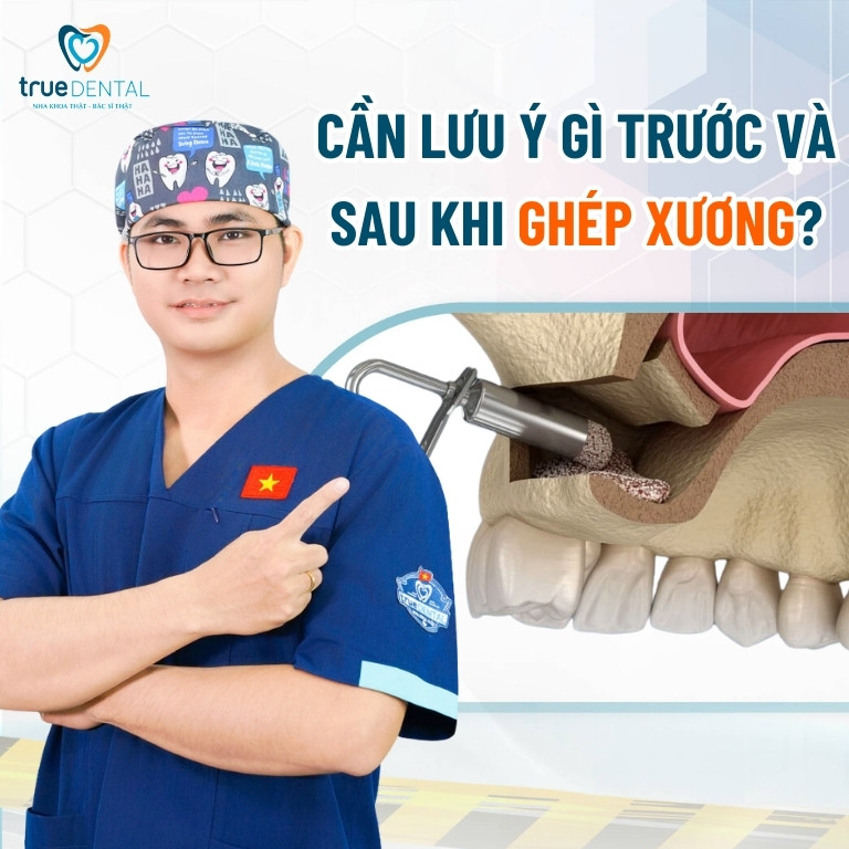 PHẪU THUẬT GHÉP XƯƠNG KHI CẤY GHÉP IMPLANT: QUY TRÌNH VÀ TRƯỜNG HỢP CẦN THỰC HIỆN 4 Cần lưu ý gì khi ghép xương?