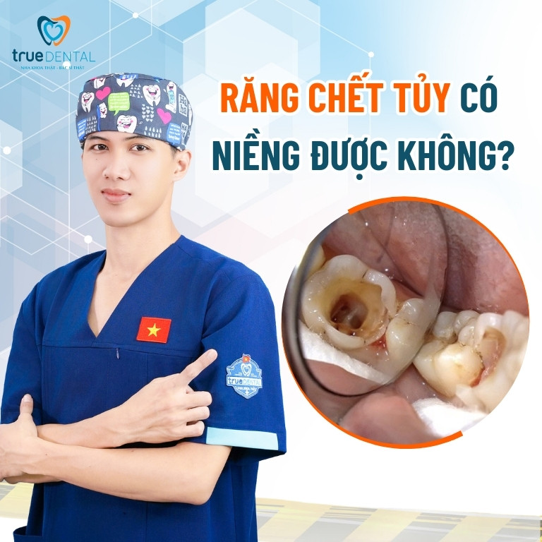 Răng chết tủy có niềng được không? Giải đáp từ bác sĩ 2 Răng chết tủy có niềng được không?