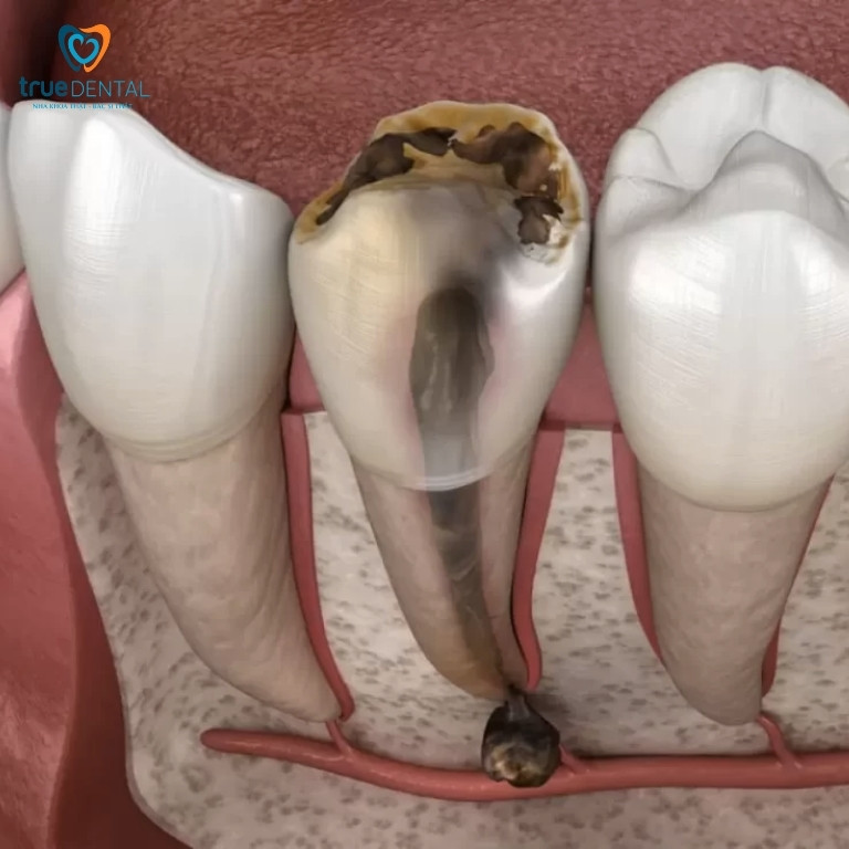 Răng chết tủy có niềng được không? Giải đáp từ bác sĩ 1 Răng chết tủy là gì?