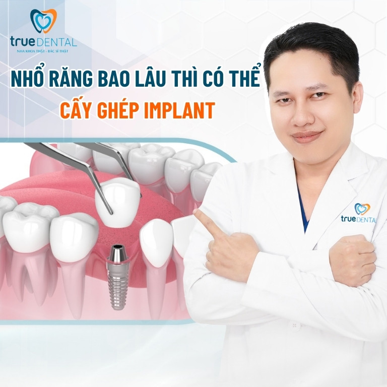 SAU KHI NHỔ RĂNG BAO LÂU THÌ CÓ THỂ CẤY GHÉP IMPLANT ĐƯỢC? 2 Sau khi nhổ răng bao lâu thì có thể cấy ghép Implant?