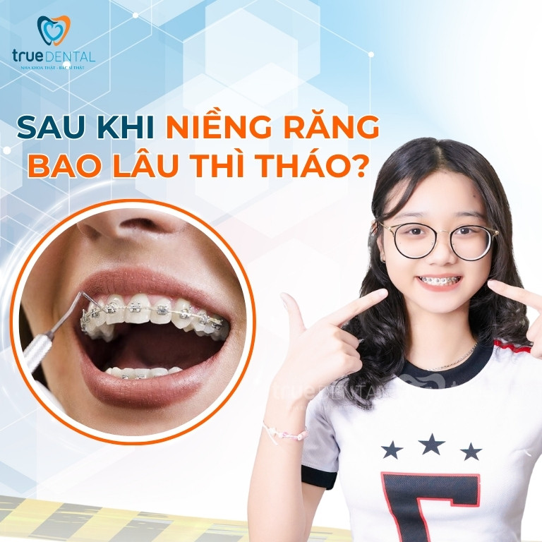 SAU KHI NIỀNG RĂNG BAO LÂU THÌ THÁO? CÓ NÊN THÁO NIỀNG SỚM KHÔNG? 1 Sau khi Niềng răng bao lâu thì tháo