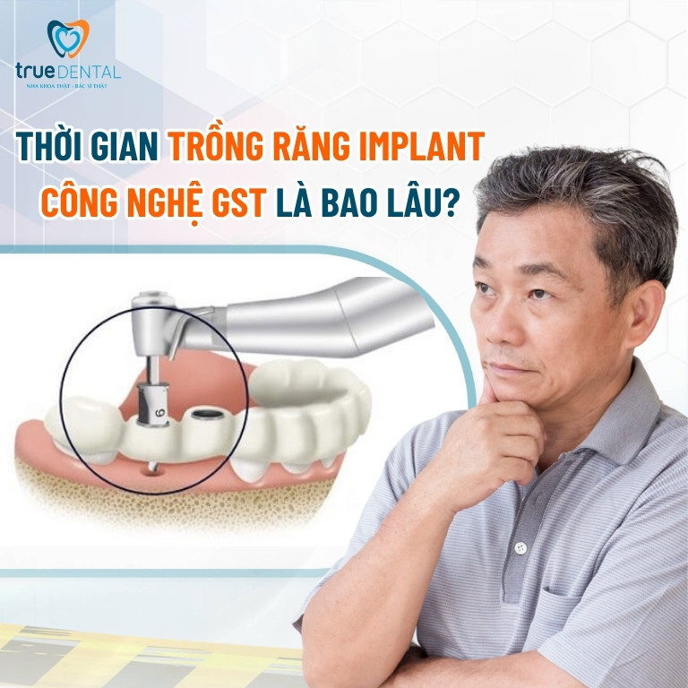 THỜI GIAN TRỒNG RĂNG IMPLANT CÔNG NGHỆ SINH HỌC GST LÀ BAO LÂU? 2 Thời gian trồng răng Implant công nghệ sinh học GST là bao lâu?