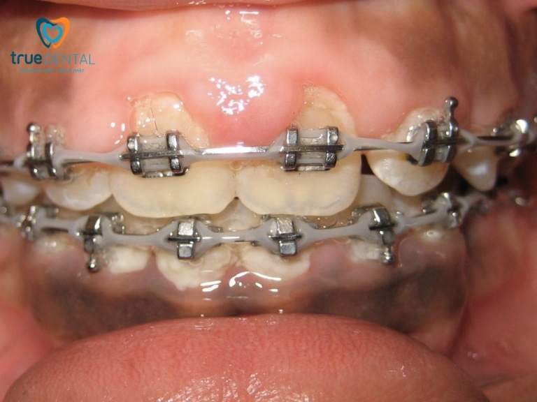 NGUYÊN NHÂN BỊ LỢI TRÙM KHI NIỀNG RĂNG VÀ CÁCH KHẮC PHỤC 1 hiện tượng lợi trùm khi niềng răng