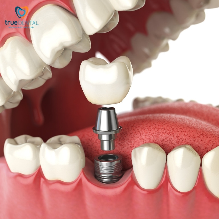 GHÉP NƯỚU LÀ GÌ? TRỒNG RĂNG IMPLANT CÓ CẦN GHÉP NƯỚU KHÔNG? 2 Trồng răng implant là gì?