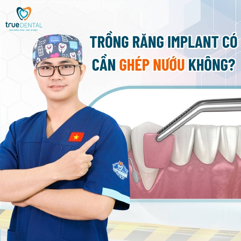 GHÉP NƯỚU LÀ GÌ? TRỒNG RĂNG IMPLANT CÓ CẦN GHÉP NƯỚU KHÔNG? 3 Trồng răng implant có cần ghép nướu không?