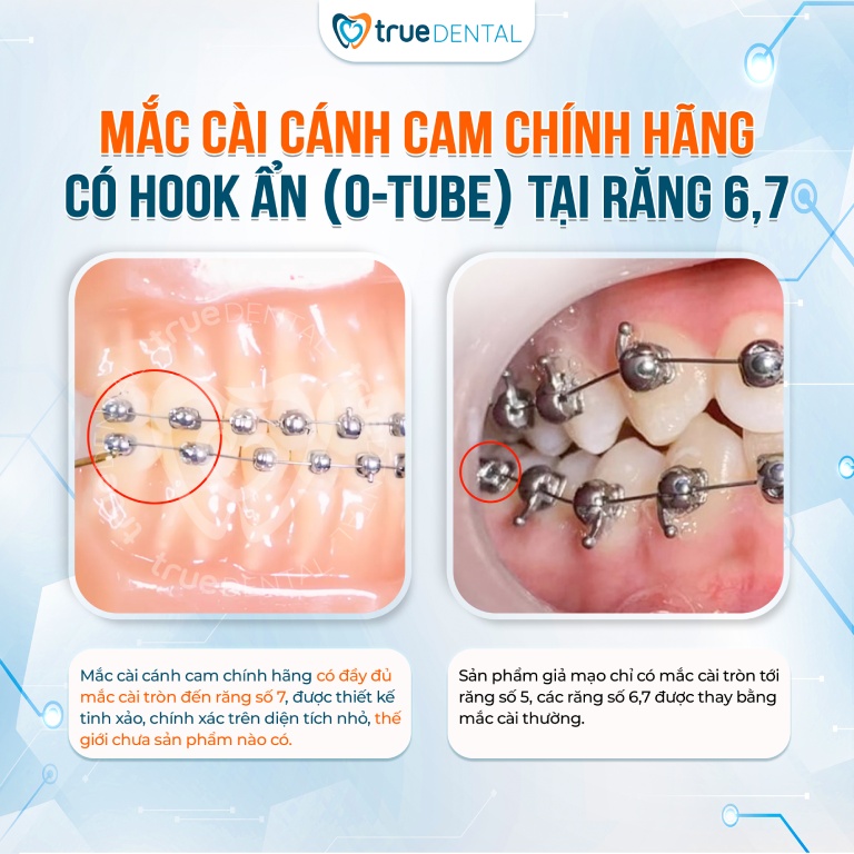 Mắc cài cánh cam chính hãng Thiết kế đặc biệt với Hook ẩn (O-Tube) tại răng số 6 và 7
