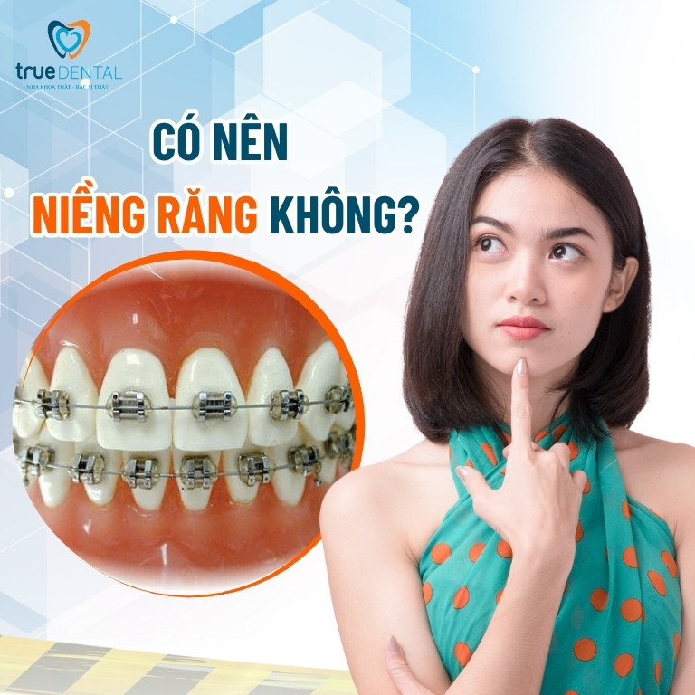 CÓ NÊN NIỀNG RĂNG KHÔNG? LỢI ÍCH VÀ TÁC HẠI CẦN BIẾT 1 Niềng răng là gì? Có nên niềng răng không?