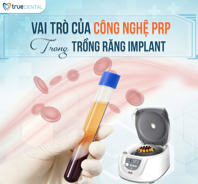 TÌM HIỂU VAI TRÒ CỦA CÔNG NGHỆ PRP TRONG TRỒNG RĂNG IMPLANT 2 Vai trò của công nghệ PRP trong trồng răng Implant