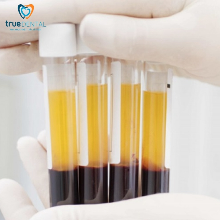 TÌM HIỂU VAI TRÒ CỦA CÔNG NGHỆ PRP TRONG TRỒNG RĂNG IMPLANT 1 Công nghệ PRP là gì?