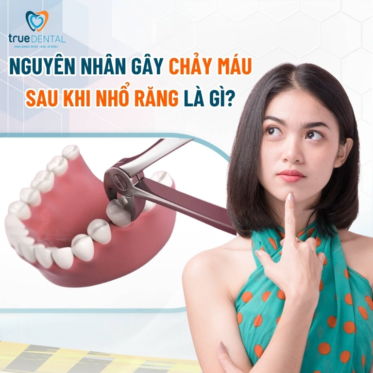 HƯỚNG DẪN CÁCH CẦM MÁU SAU KHI NHỔ RĂNG HIỆU QUẢ 1 Nguyên nhân gây chảy máu sau khi nhổ răng