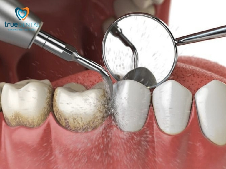LẤY CAO RĂNG CÓ TỐT KHÔNG? LỢI ÍCH VÀ QUY TRÌNH THỰC HIỆN CHUẨN Y KHOA 1 Lấy cao răng là gì