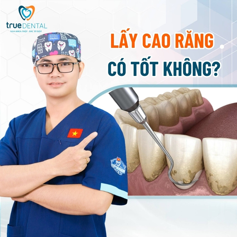LẤY CAO RĂNG CÓ TỐT KHÔNG? LỢI ÍCH VÀ QUY TRÌNH THỰC HIỆN CHUẨN Y KHOA 2 Lấy cao răng có tốt không?