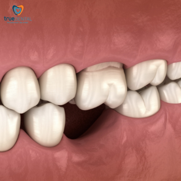 Mất răng và những ảnh hưởng đến sức khỏe răng miệng