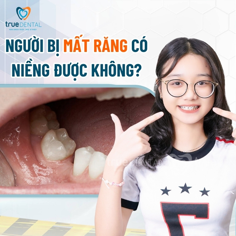 Người bị mất răng có niềng răng được không?