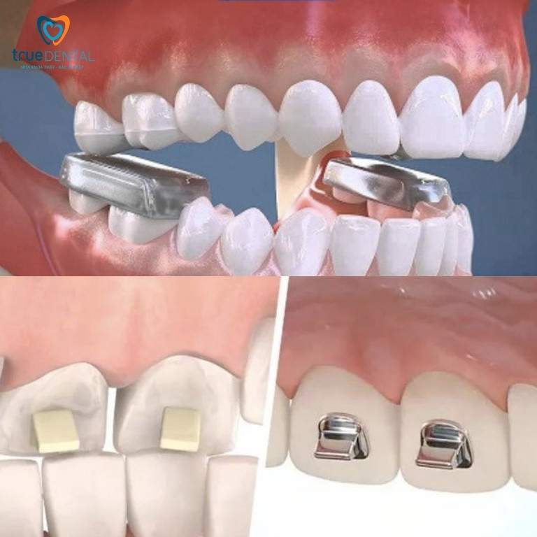 NÂNG HÀM KHI NIỀNG RĂNG CÓ TÁC DỤNG GÌ? CÓ ĐAU KHÔNG? 1 Nâng hàm trong niềng răng