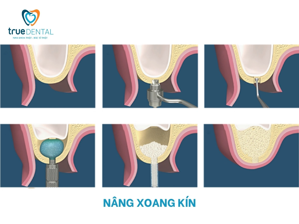 NÂNG XOANG KÍN LÀ GÌ? KHI NÀO CẦN THỰC HIỆN? 3 Quy trình thực hiện nâng xoang kín