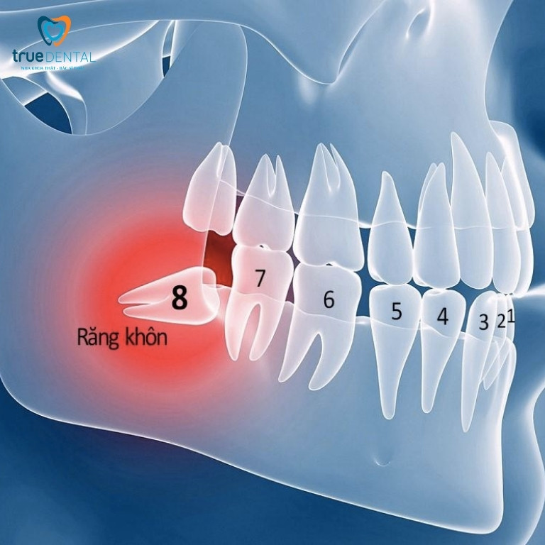 NHỔ RĂNG KHÔN CÓ NGUY HIỂM KHÔNG? GIẢI ĐÁP TỪ BÁC SĨ TRUE DENTAL 1 Răng khôn là răng nào?