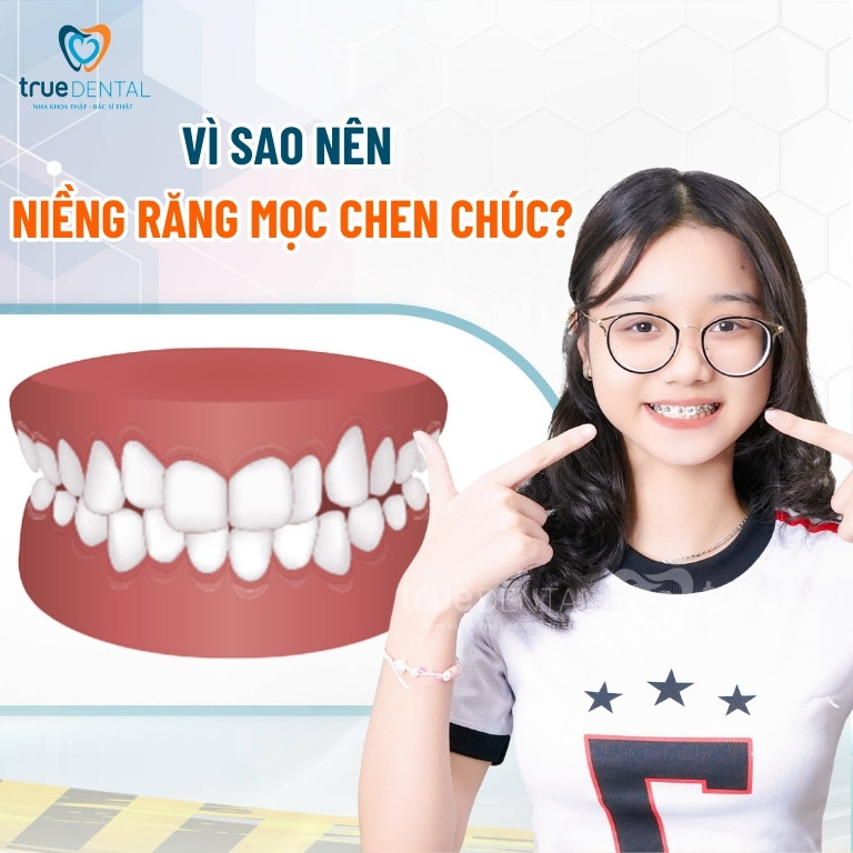 NIỀNG RĂNG MỌC CHEN CHÚC BẰNG PHƯƠNG PHÁP NÀO TỐT NHẤT? 2 Vì sao nên niềng răng mọc chen chúc?