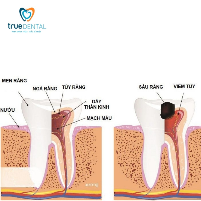 Viêm tủy răng: Dấu hiệu, nguyên nhân, cách phòng ngừa 1 Răng bị viêm tủy là gì?