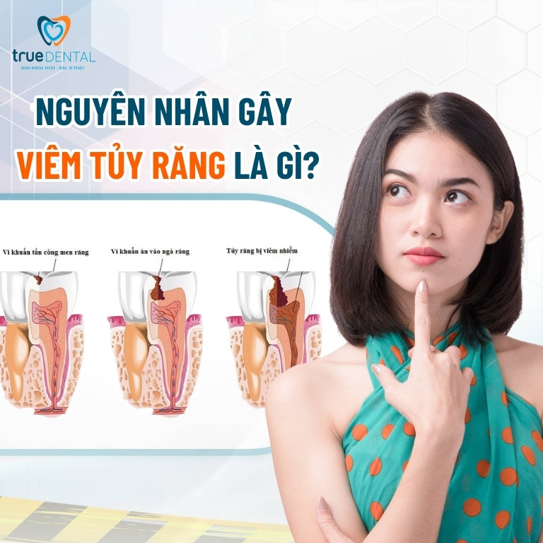 Viêm tủy răng: Dấu hiệu, nguyên nhân, cách phòng ngừa 3 Nguyên nhân gây viêm tủy răng