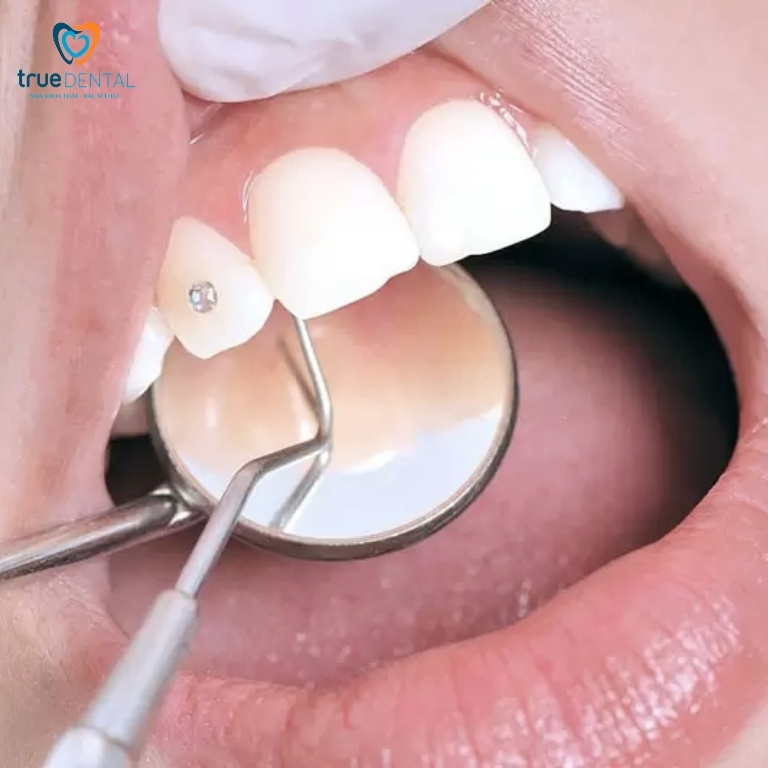 Xu hướng đính đá thẩm mỹ cho răng