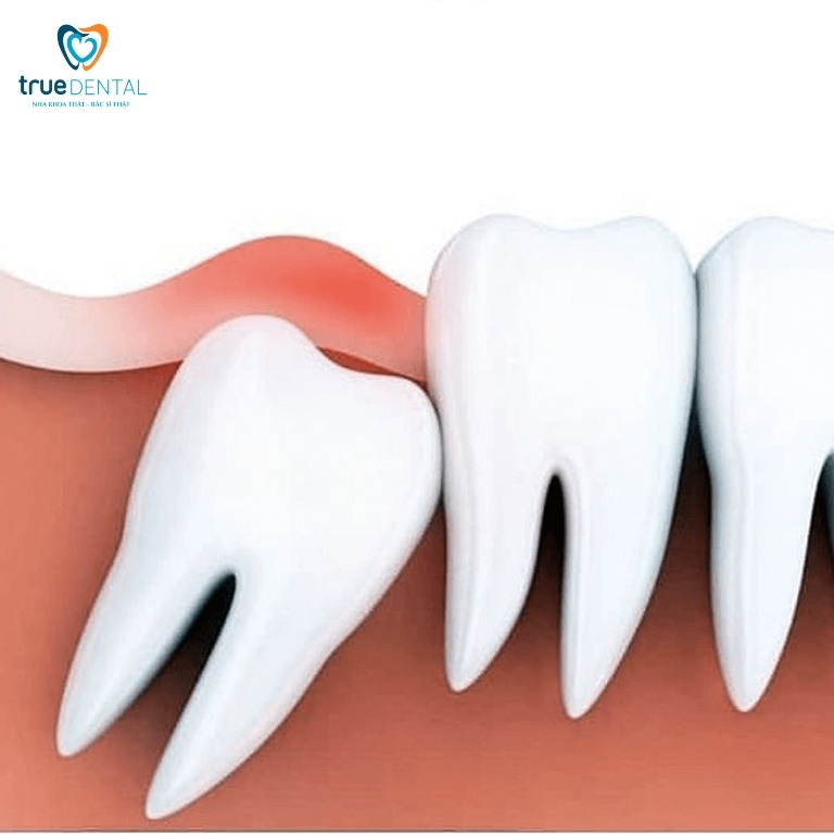 SƯNG NƯỚU RĂNG CÓ NGUY HIỂM KHÔNG? NGUYÊN NHÂN VÀ CÁCH ĐIỀU TRỊ 1 Sưng nướu răng là gì?