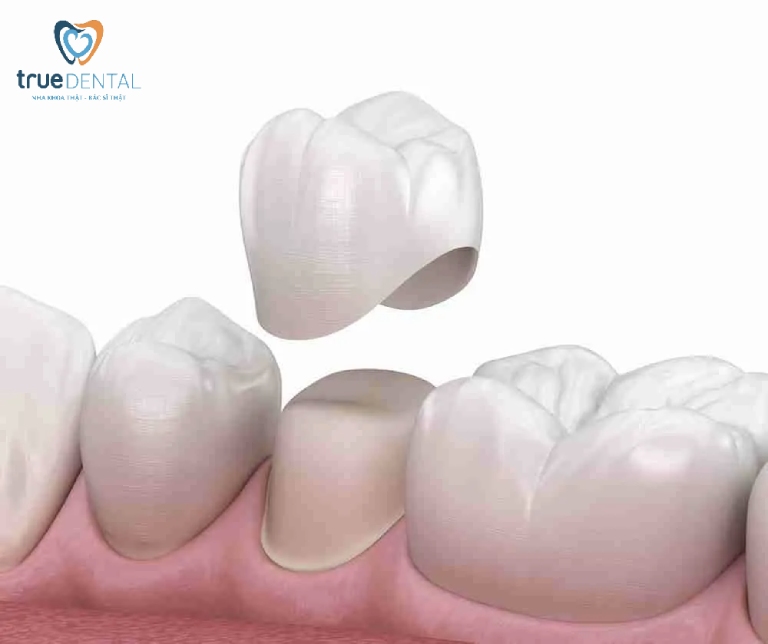 Bọc răng sứ là gì? Giá bọc răng sứ, quy trình thực hiện 5 phương pháp bọc răng sứ