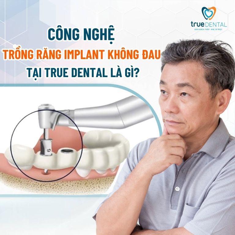 TÌM HIỂU VỀ CÔNG NGHỆ TRỒNG RĂNG IMPLANT KHÔNG ĐAU TẠI TRUE DENTAL 1 Công nghệ trồng răng Implant không đau tại True Dental là gì?