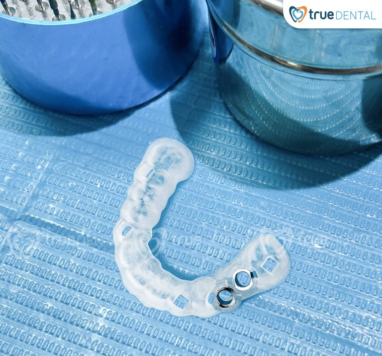TÌM HIỂU VỀ CÔNG NGHỆ TRỒNG RĂNG IMPLANT KHÔNG ĐAU TẠI TRUE DENTAL 3 Máng định vị phẫu thuật AI là gì?