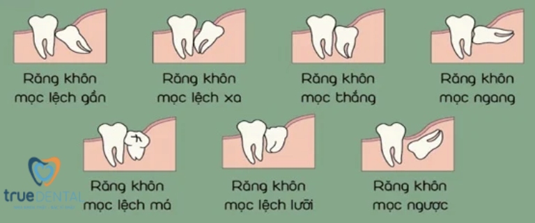 Dấu hiệu mọc răng khôn phổ biến, cách giảm triệu chứng 3 Cách nhận biết hướng mọc của răng khôn