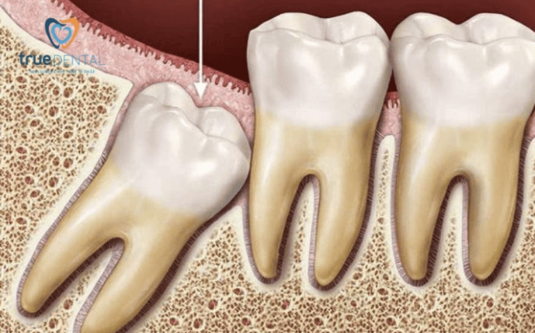 Dấu hiệu mọc răng khôn phổ biến, cách giảm triệu chứng 2 Quá trình mọc răng khôn