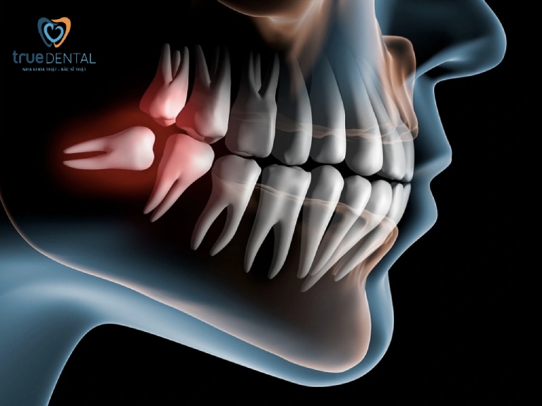 Dấu hiệu mọc răng khôn phổ biến, cách giảm triệu chứng 1 Tại sao lại mọc răng khôn?