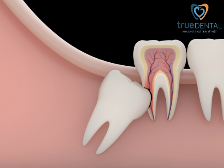 Đau răng khôn - Cách giảm đau nhanh nhất tại nhà đơn giản 2 Răng khôn mọc lệch hoặc ngầm