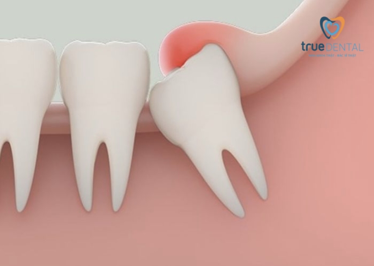 Đau răng khôn - Cách giảm đau nhanh nhất tại nhà đơn giản 3 Viêm nhiễm mô mềm gây đau răng khôn