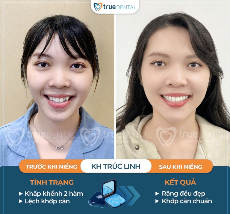 Niềng răng không mắc cài là gì? Có nên niềng răng không mắc cài 8 Hình ảnh trước và sau khi niềng răng không mắc cài