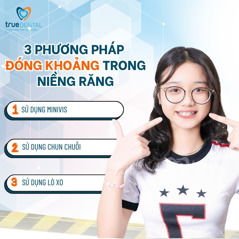 ĐÓNG KHOẢNG TRONG NIỀNG RĂNG LÀ GÌ? DIỄN RA THẾ NÀO? MẤT BAO LÂU? 2 Phương pháp đóng khoảng trong niềng răng