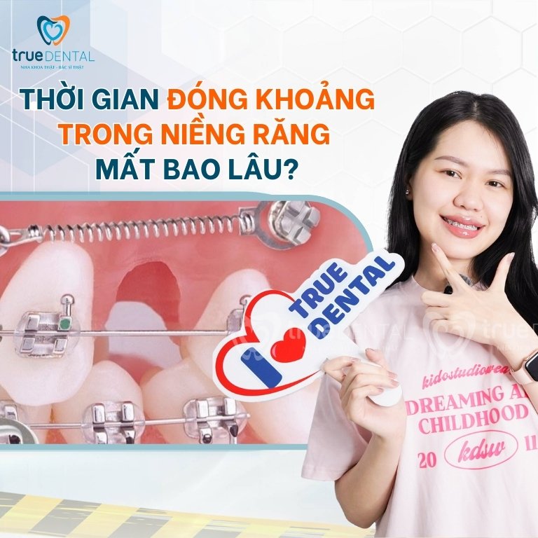 ĐÓNG KHOẢNG TRONG NIỀNG RĂNG LÀ GÌ? DIỄN RA THẾ NÀO? MẤT BAO LÂU? 4 Thời gian đóng khoảng trong niềng răng mất bao lâu?