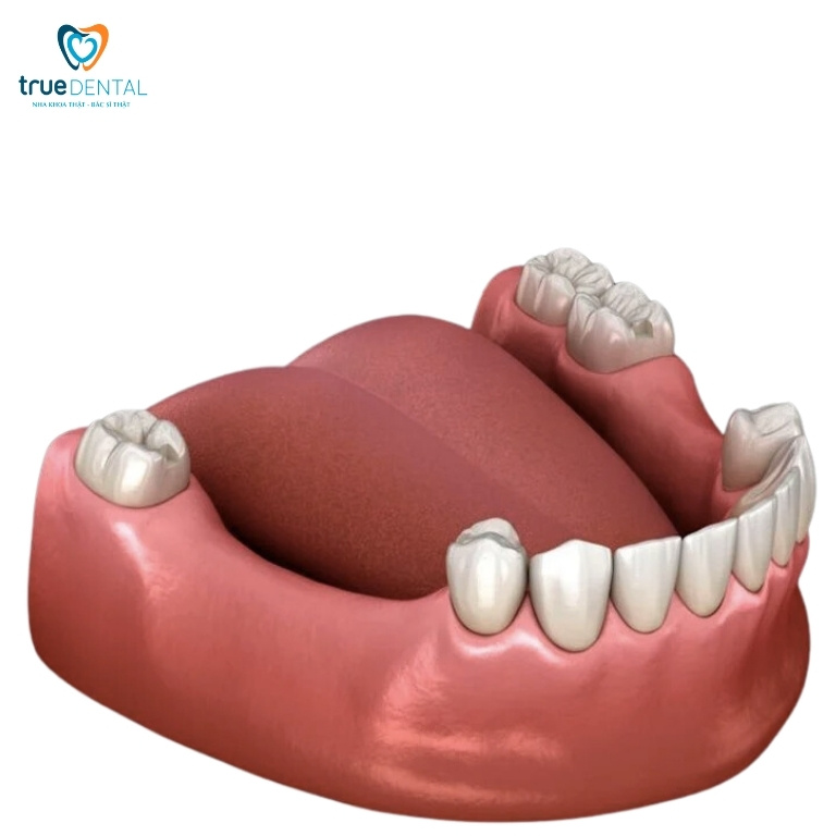 MẤT 3 RĂNG LIÊN TIẾP CÓ SAO KHÔNG? PHỤC HÌNH BẰNG PHƯƠNG PHÁP NÀO? 1 Tác hại của việc mất 3 răng liên tiếp