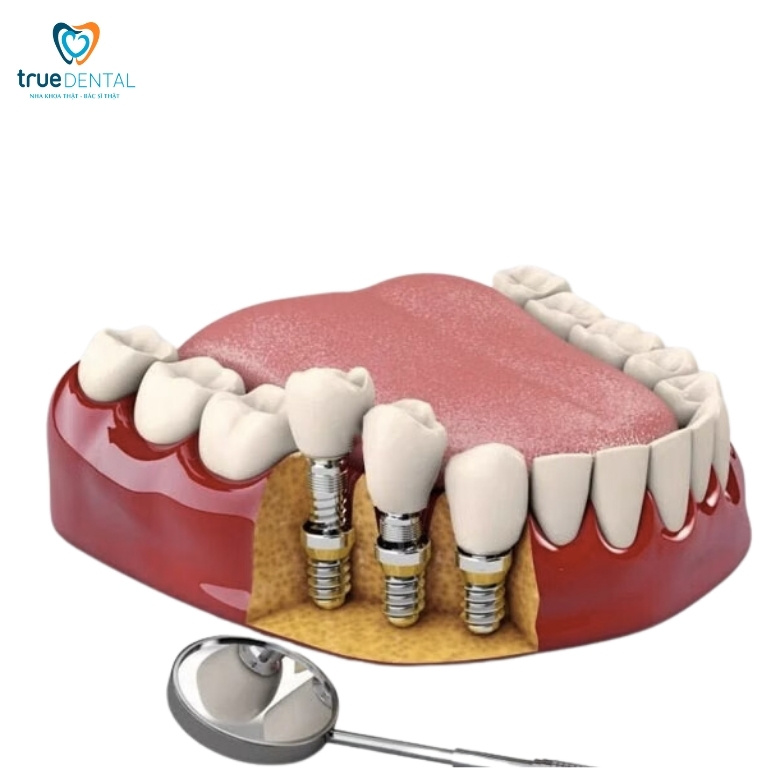 MẤT 3 RĂNG LIÊN TIẾP CÓ SAO KHÔNG? PHỤC HÌNH BẰNG PHƯƠNG PHÁP NÀO? 2 Trồng răng Implant
