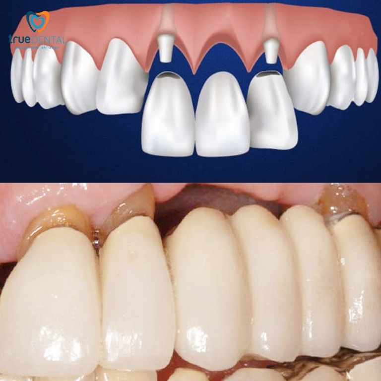 MẤT 3 RĂNG LIÊN TIẾP CÓ SAO KHÔNG? PHỤC HÌNH BẰNG PHƯƠNG PHÁP NÀO? 3 Cầu răng sứ