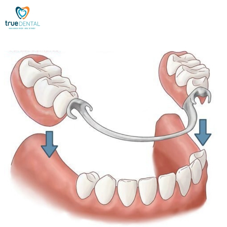 MẤT 3 RĂNG LIÊN TIẾP CÓ SAO KHÔNG? PHỤC HÌNH BẰNG PHƯƠNG PHÁP NÀO? 4 Hàm giả tháo lắp