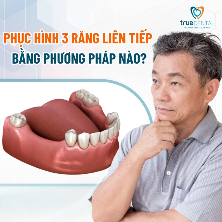 MẤT 3 RĂNG LIÊN TIẾP CÓ SAO KHÔNG? PHỤC HÌNH BẰNG PHƯƠNG PHÁP NÀO? 5 Nên chọn phục hình 3 răng liên tiếp bằng phương pháp nào?