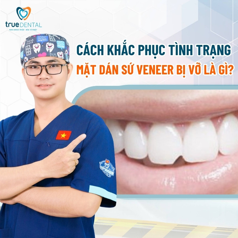 LÝ DO KHIẾN MẶT DÁN SỨ VENEER BỊ NỨT, VỠ? KHẮC PHỤC BẰNG CÁCH NÀO? 3 Cách khắc phục tình trạng mặt dán sứ Veneer bị nứt, vỡ