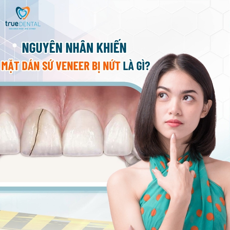 LÝ DO KHIẾN MẶT DÁN SỨ VENEER BỊ NỨT, VỠ? KHẮC PHỤC BẰNG CÁCH NÀO? 2 Nguyên nhân khiến mặt dán sứ Veneer bị nứt, vỡ là gì?